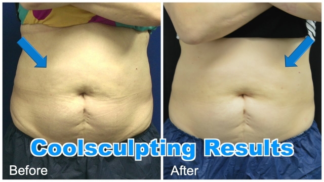 Chill Out: Unveiling the Magic of Cool Sculpting and Fat Freezing