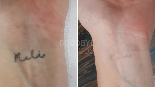 Is Tca Tattoo Removal Something Which You Can Consider?