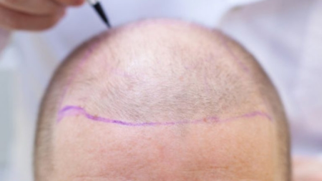 Revitalizing Your Hairline: Unveiling the Secrets of Hair Implants