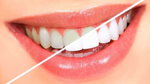 Smile Brighter with Crest Whitening Strips: A Game-Changing Oral Care Solution