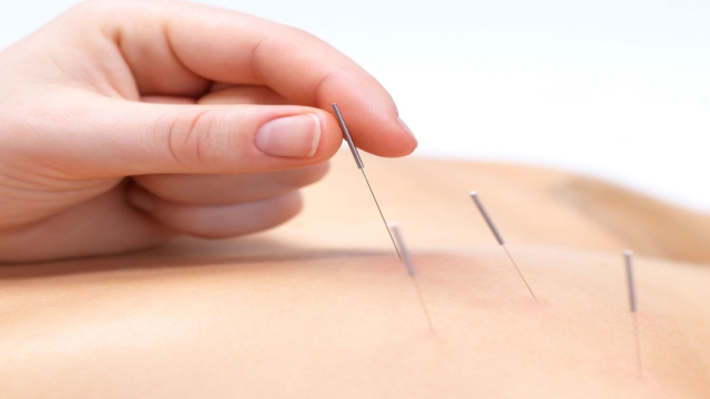 The Art of Acupuncture: Unveiling the Ancient Healing Wonders